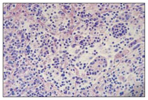 Extranodal Rosai Dorfman Disease Involving The Meninges In A 79 Year