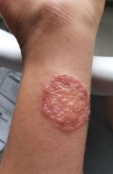 Shocking Giant Hogweed Blister Solihull Mum Wants You To See After