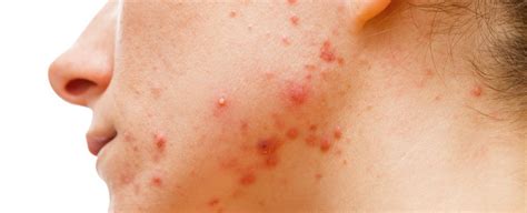 Researchers Might Have Figured Out Why Bacteria Only Causes Acne In