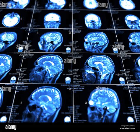 Magnetic Resonance Imaging Of The Brain Stock Photo Alamy