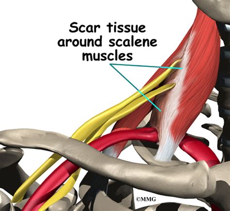 Thoracic Outlet Syndrome