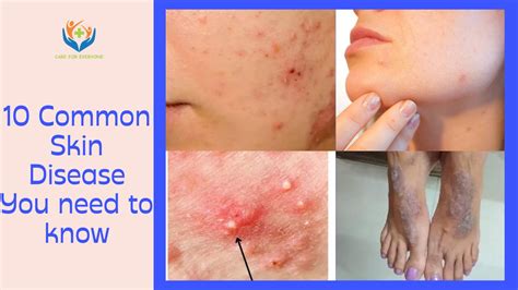 10 Common Skin Disease You Need To Know Jayyush Hospital
