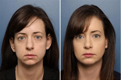 How Much Downtime To Expect After Rhinoplasty Raleigh Rhinoplasty