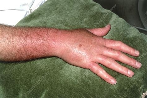 Inflammation Due To Cellulitis On A Mans Hand Stock Image M130