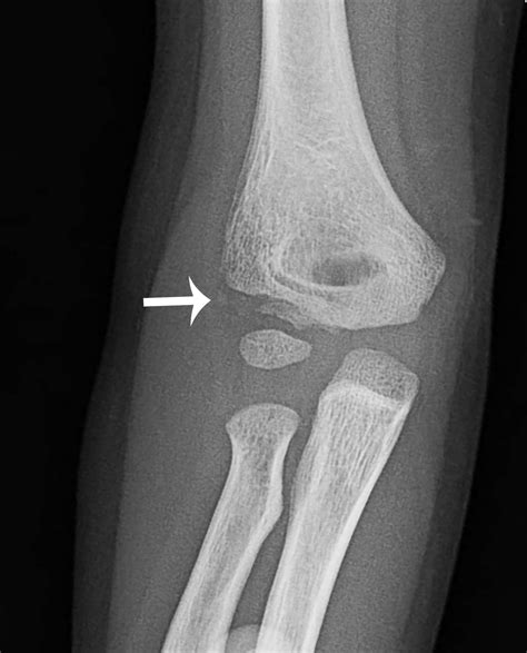 Lateral Condyle Fracture Milch