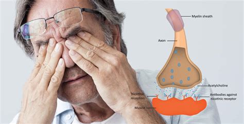 Although myasthenia gravis can affect any of the muscles that you control voluntarily, certain muscle groups are more commonly affected than others. Myasthenia Gravis & Natural Symptom Management - Dr. Axe