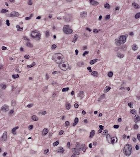 Pathology Outlines Lymphocyte Depleted Classic Hodgkin Lymphoma
