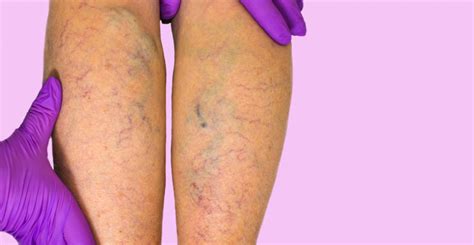 Homeopathic Treatment For Venous Insufficiency Homeopathy At