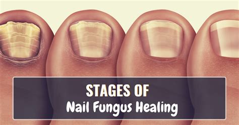 All Stages Of Nail Fungus Healing Pictures Included