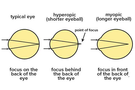 What Is The Definition Of High Myopia Severe Nearsightedness