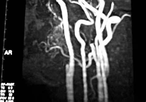 Angio Ct After Ligation Of External Carotid Artery Confirmed Integrity