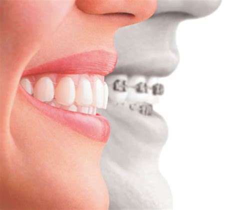 Orthodontic Treatment In Nagpur Orthodontics Orthodontist In Nagpur