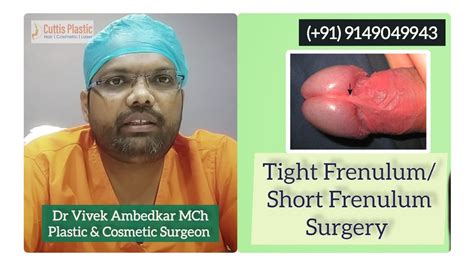 Tight Frenulum Frenuloplasty Short Frenulum Circumcision Rewa Youtube