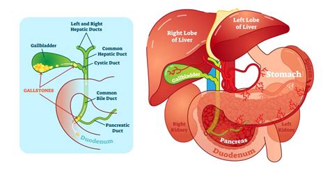 Bile Duct Obstruction Symptoms Causes And Treatments