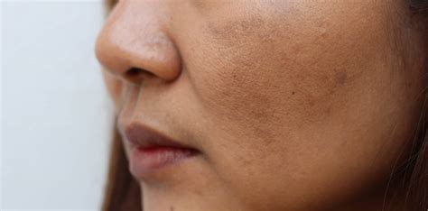 Fotona 3d Laser Resurfacing For Dull And Uneven Skin Tone In Singapore