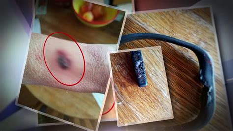 Woman Claims Fitbit Exploded On Her Wrist Abc7 Los Angeles