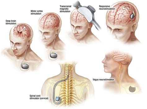 Neurostimulation Devices For The Treatment Of Neurologic Disorders