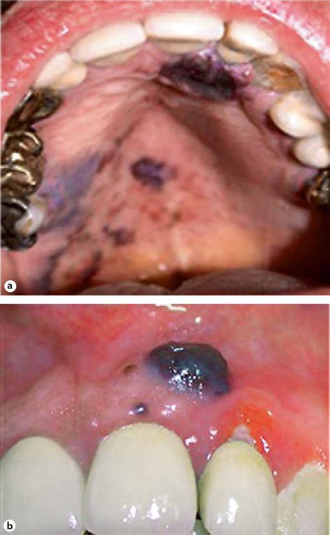 Figure 1 From Oral Malignant Melanoma Initially Misdiagnosed As A