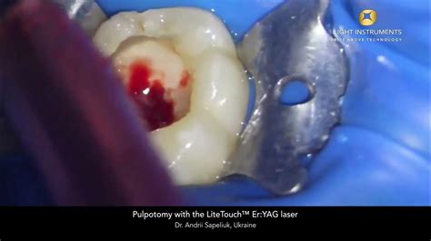 Pulpotomy With The Litetouch™ Eryag Laser Youtube