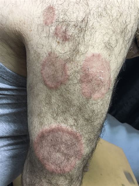 Multiple Annular Mid‐atrophic Erythematous Plaques On Arm Download