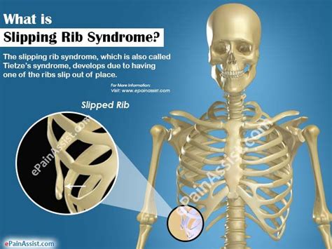 Pin On Nats Surgery For Slipping Rib Syndrome