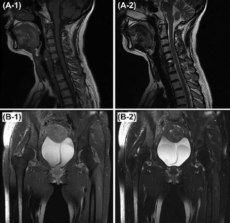 A Mri Of Cervical Spine A Sagittal T Wi A Sagittal T Wi Download Scientific