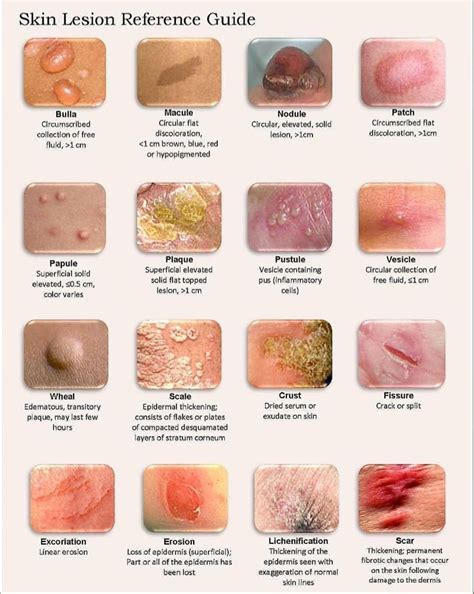 Types Of Skin Lesions Neet Pg Medicaltalk Net The Best Medical