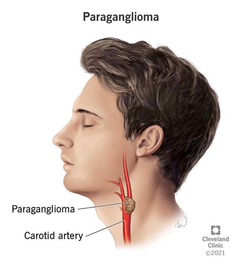 Paraganglioma Causes Symptoms And Treatment