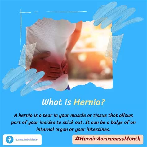 Ppt What Is Hernia Hernia Surgery In Bangalore Hsr Layout