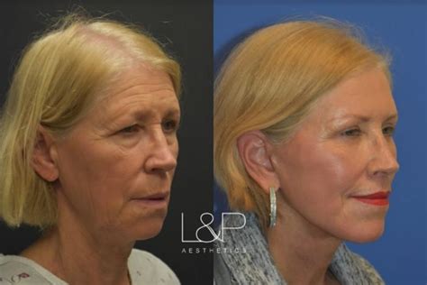 Laser Resurfacing Trl Before And After Photo Gallery Palo Alto
