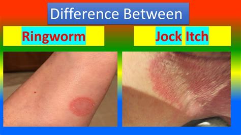 Difference Between Ringworm And Jock Itch Youtube