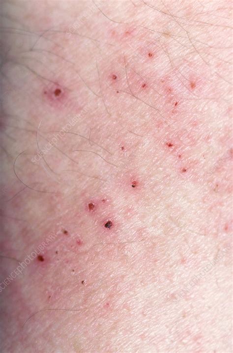 Scabies Stock Image C014 4367 Science Photo Library