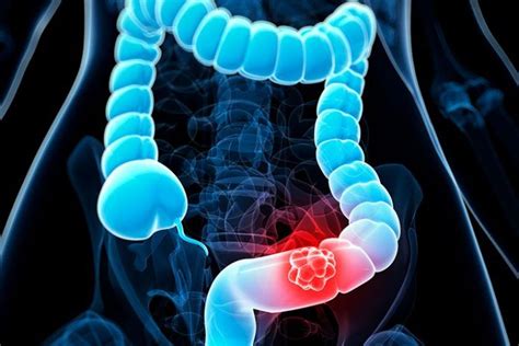 Colon Cancer Types Stages Diagnosis Treatment And Prevention