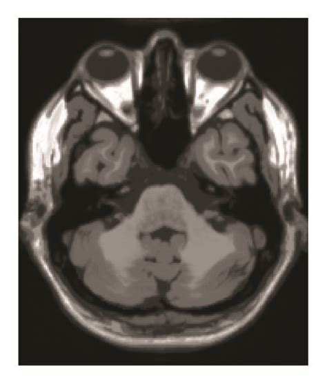 T1 Weighted T2 Weighted And Pd Weighted Mri Brain Images Download