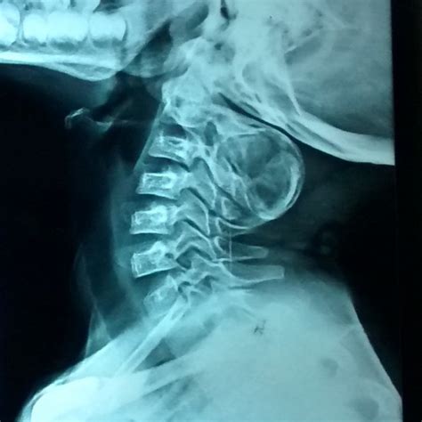 Pdf Aneurysmal Bone Cyst Of C Cervical Spine Presenting As An Asymptomatic Posterior Neck