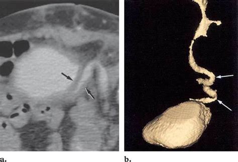 Ureteral Anastomosis A Axial Contrast Enhanced Ct Scan Demonstrates