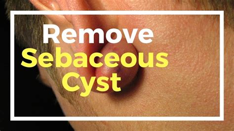 18 Remedies To Remove Sebaceous Cyst Naturally At Home Youtube