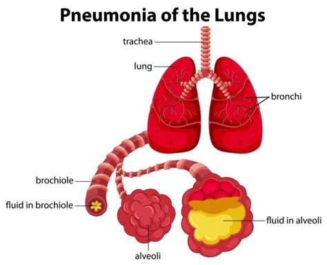 Learn about causes, risk factors, prevention, signs and symptoms. Delay in pneumonia diagnosis, treatment can cause child's death
