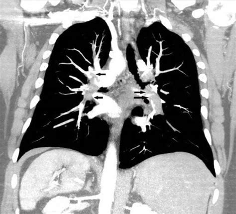 Image Coronal Reconstruction Ct Pulmonary Angiography Merck Manuals