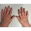How Hand Osteoarthritis Is Associated With Pain And Function 