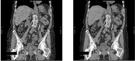 Radiation Dose In Ct Scans And Image Quality