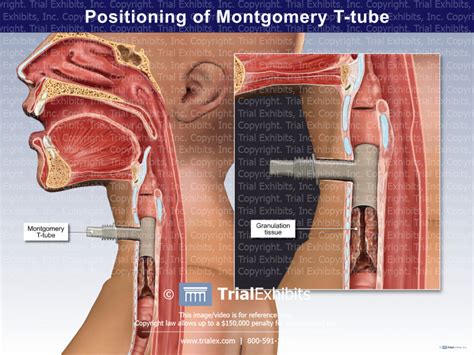 Positioning Of Montgomery T Tube Trialexhibits Inc