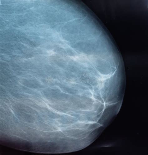 X Rays Digital Mammography A Method Of X Raying A Woman`s Breast For