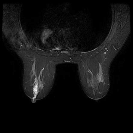 Intraductal Papilloma Breast MRI Image Radiopaedia Org