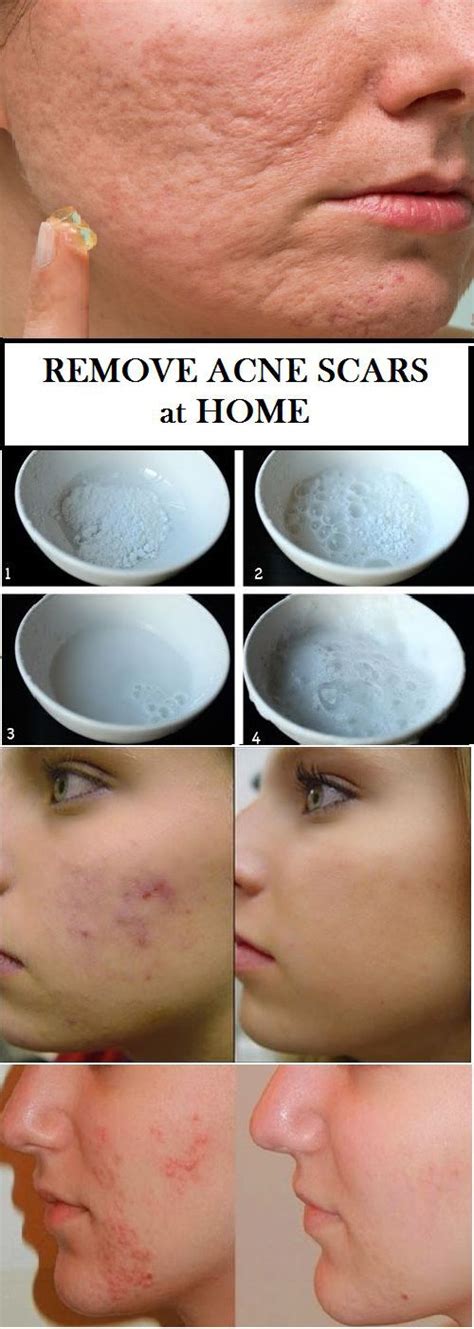 How To Remove Acne Scars Naturally At Home Health Fitness Beauty