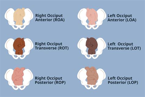 Vertex Position Fetal Position In
