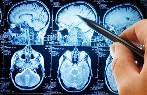What You Need To Know About Brain Cancer Afcr
