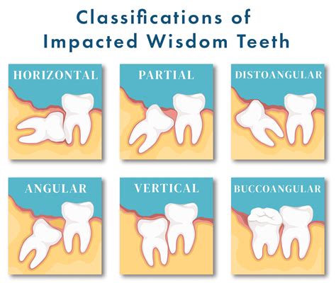 Painless And Cost Effective Wisdom Teeth Removal In Gurgaon Dantkriti