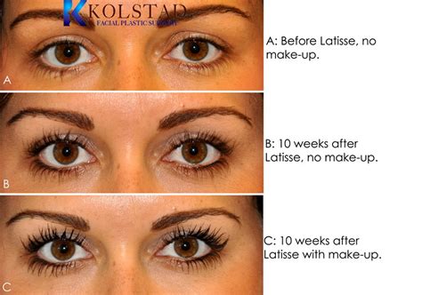 Does Latisse Work On Eyebrows