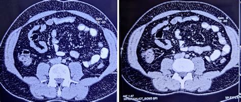 Ct Scan Abdomen Showed Swelling With Inflammatory Changes Along The